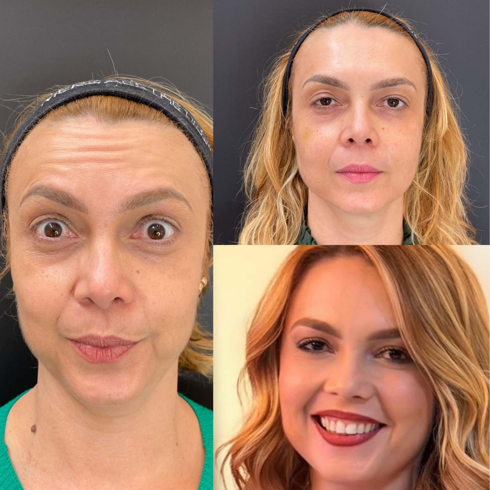 Antes e depois · rosto