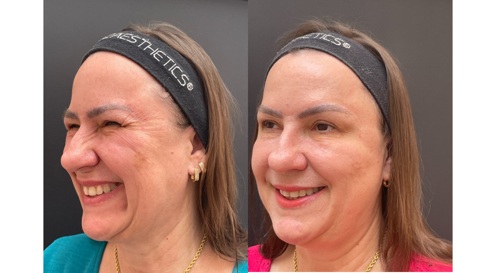 Antes e depois · lábios