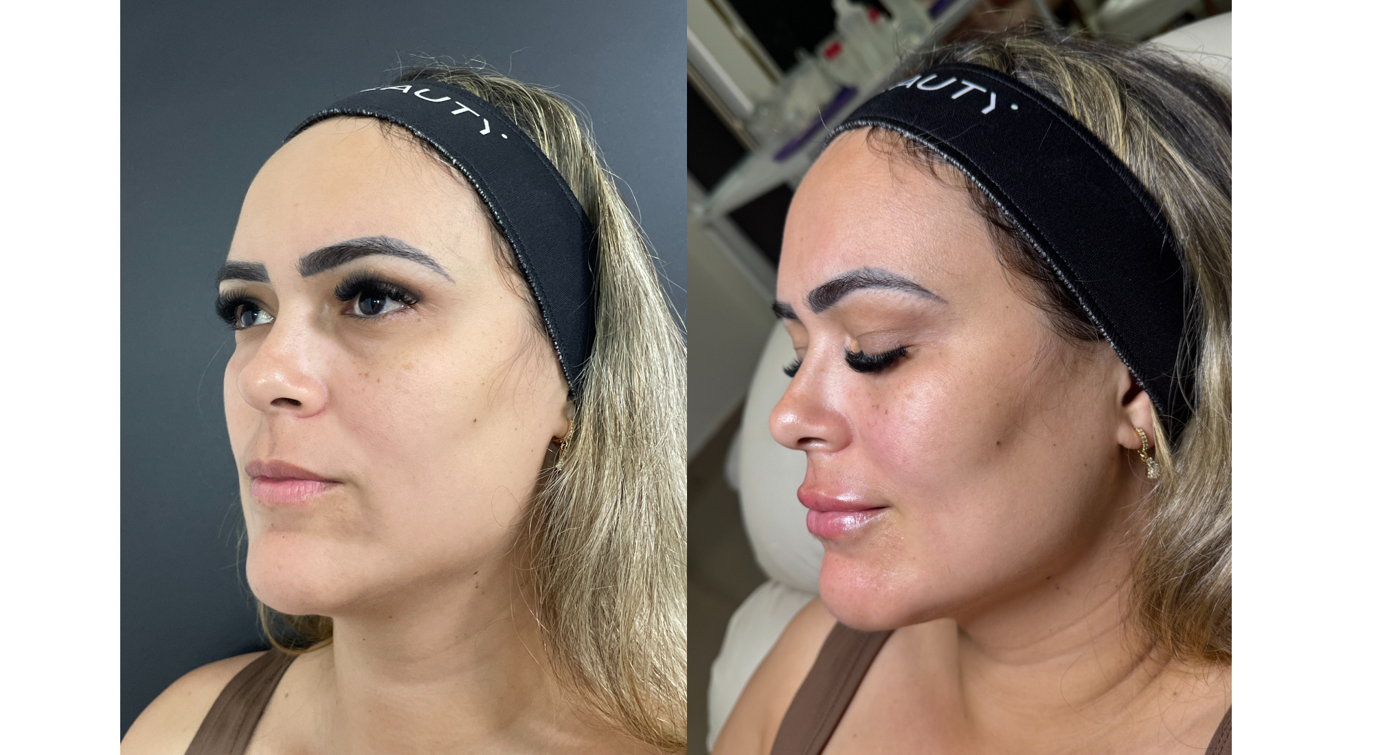 Antes e depois · perfil