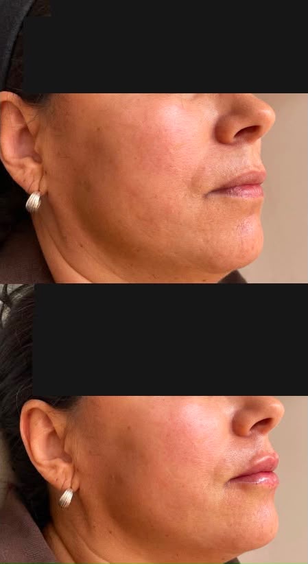 Rejuvenescimento facial · antes e depois